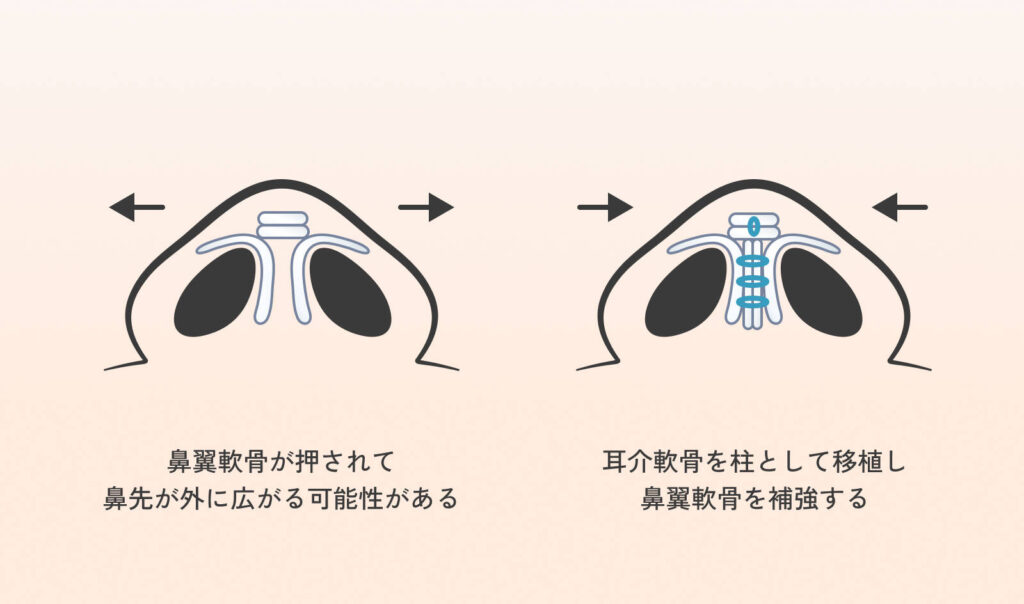 Illustration explaining cartilage grafting in septal extension surgery. Schematic diagram of a surgical technique that fixes cartilage from both ears to the nasal septum using a specialized method, achieving significant changes comparable to rib cartilage and minimal relapse.