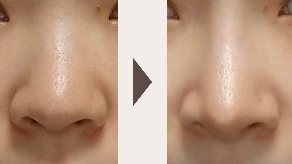 Case photos of nasal bone reduction (osteotomy). Before the procedure on the left, the nasal bridge appears thick and wide. After the procedure on the right, the nasal bridge is refined and narrowed, achieving a natural straight line.