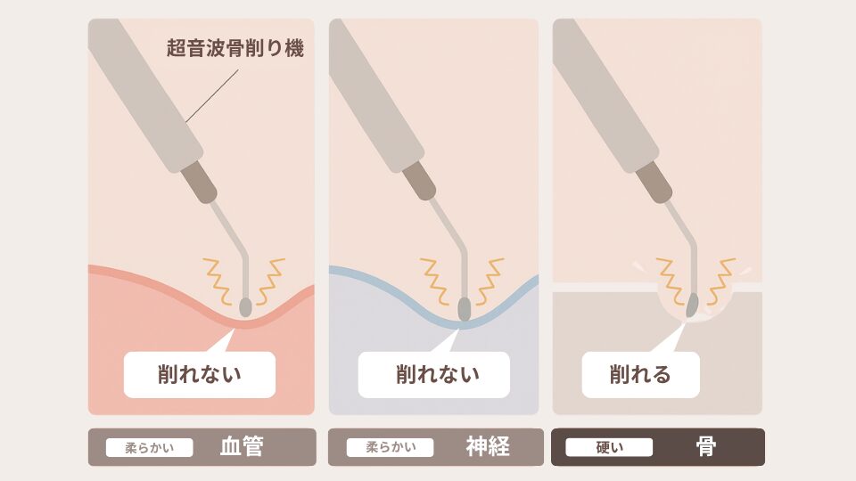 A comparative diagram illustrating the features of an ultrasonic bone shaver. It visually explains the mechanism in three steps: how it selectively shaves only hard "bone" while not reacting to or shaving soft tissues like "blood vessels" and "nerves."