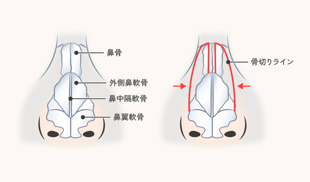 Illustration explaining the nasal bone reduction (osteotomy reduction) procedure. The left side shows the nasal skeletal structure (nasal bones, lateral nasal cartilage, nasal septal cartilage, alar cartilage). The right side depicts the "osteotomy line" with a red line and arrows indicating the force applied to bring the structure toward the center.