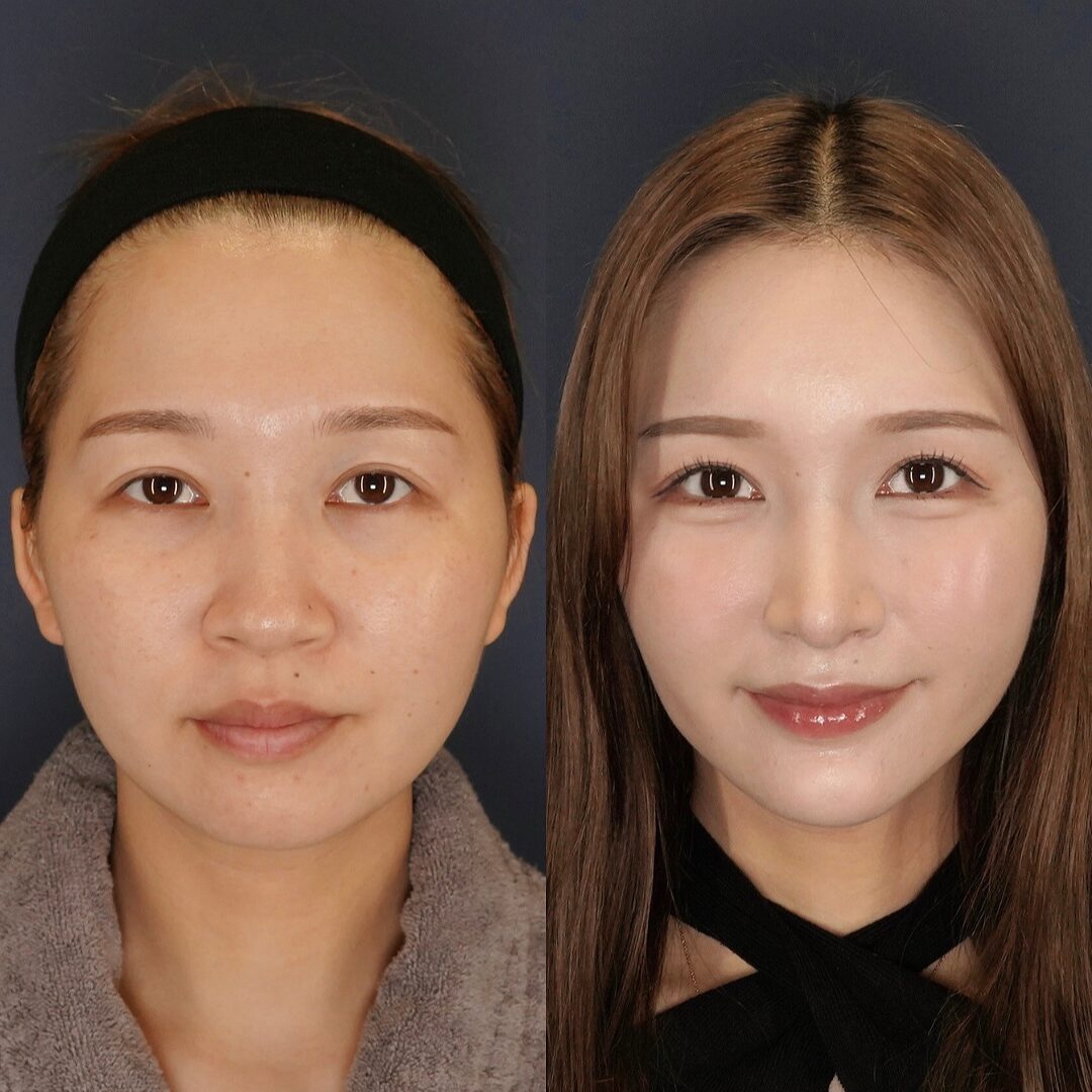鼻中隔延長(耳介軟骨)、鼻尖形成、鼻翼縮小(内側)CRF脂肪注入(額、ゴルゴ、目の下)、サクションリフト、ヒアルロン酸:顎、涙袋