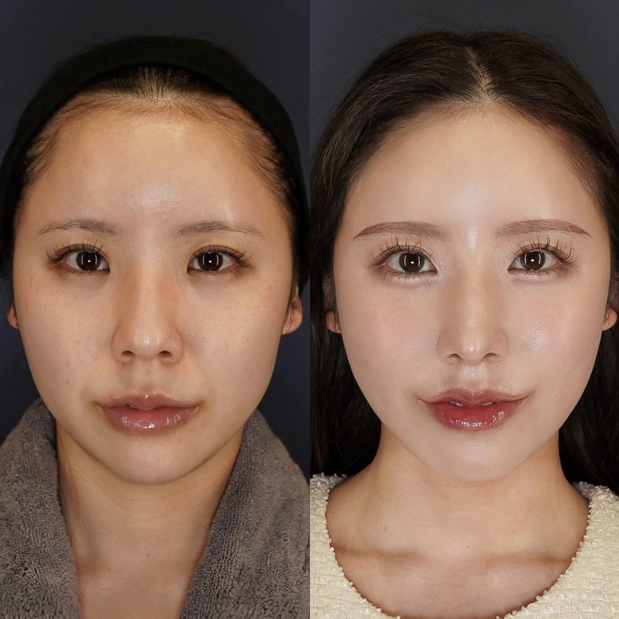 鼻プロテーゼ、骨切り幅寄せ、鼻中隔延長(耳介)、鼻尖形成、Cカール形成(猫手術)、鼻翼縮小