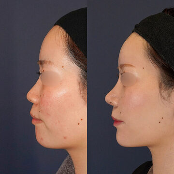 鼻プロテーゼ、骨切り幅寄せ、鼻中隔延長(耳介)、鼻尖形成、Cカール形成(猫手術)、鼻翼縮小