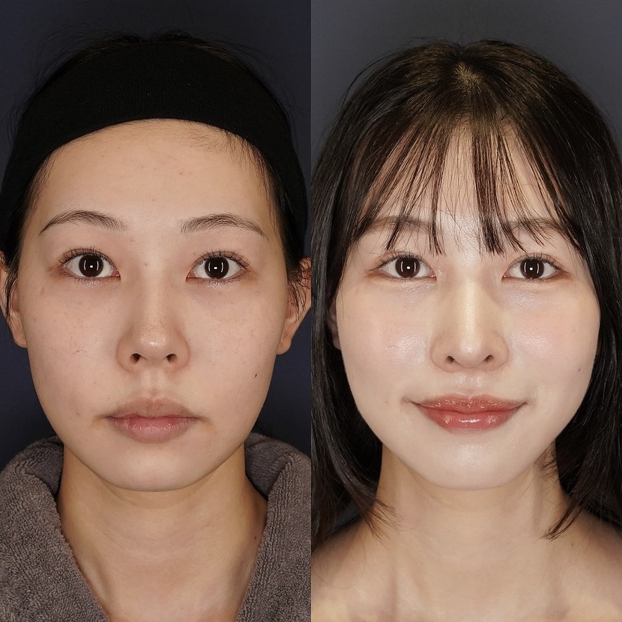 鼻中隔延長(耳介軟骨)、鼻尖形成、鼻孔縁下降(皮膚+軟骨移植)