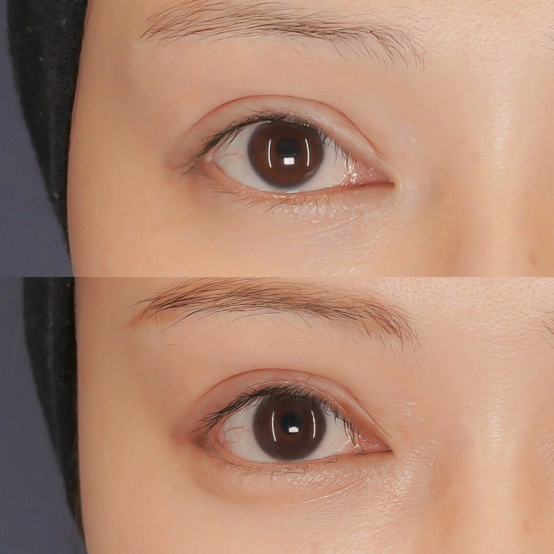 タレ目尻切開m、ハム目修正（睫毛上皮膚切除）