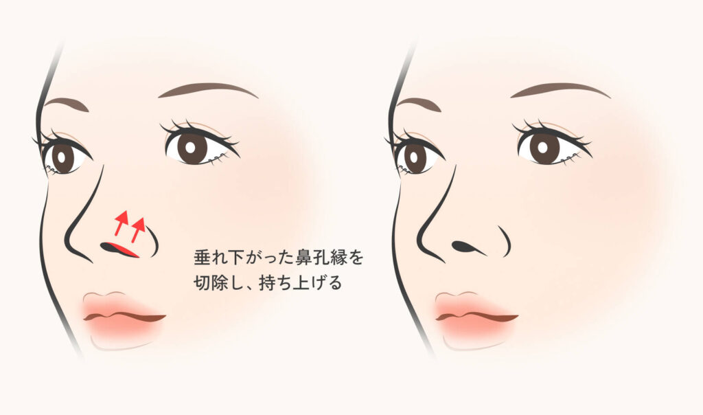 鼻孔縁挙上術による変化を示した図解