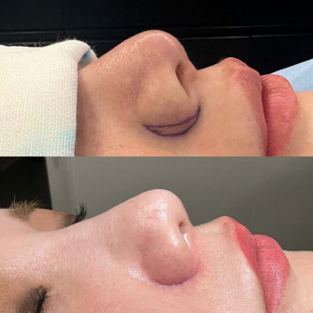 鼻翼縮小（小鼻縮小）の外側法の切開位置をマークした鼻