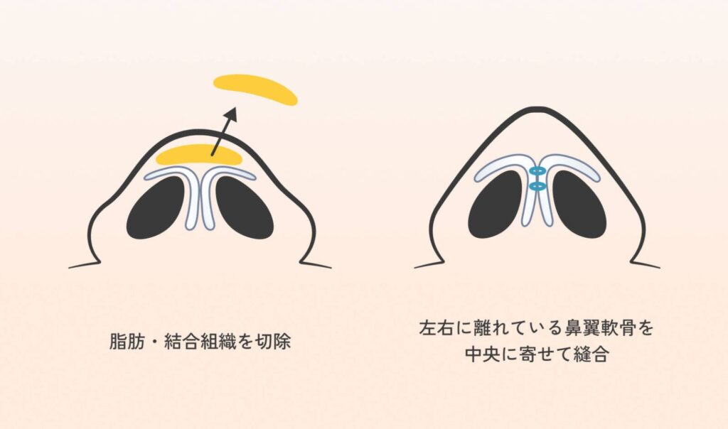 鼻尖形成・鼻尖縮小の手術イメージ図