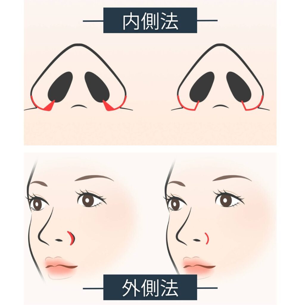 Illustration of the Medial and Lateral Approaches for Nasal Wing Reduction