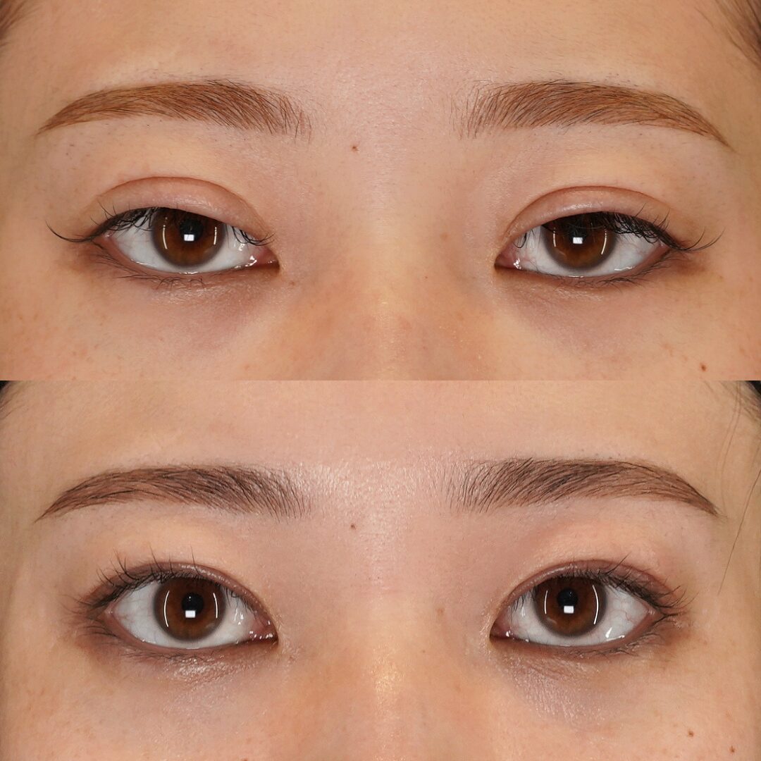 二重全切開 他院修正