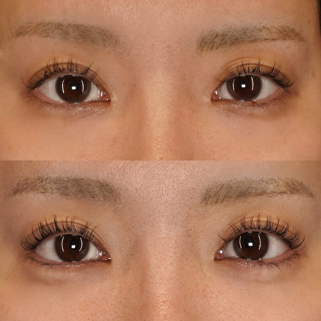 ３WAY目尻拡大術