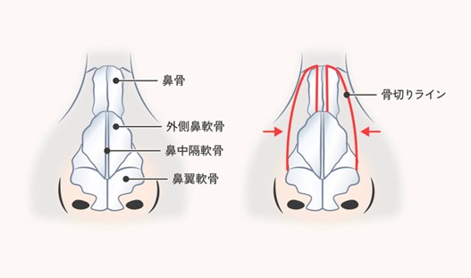 鼻骨骨切り幅寄せ術の方法