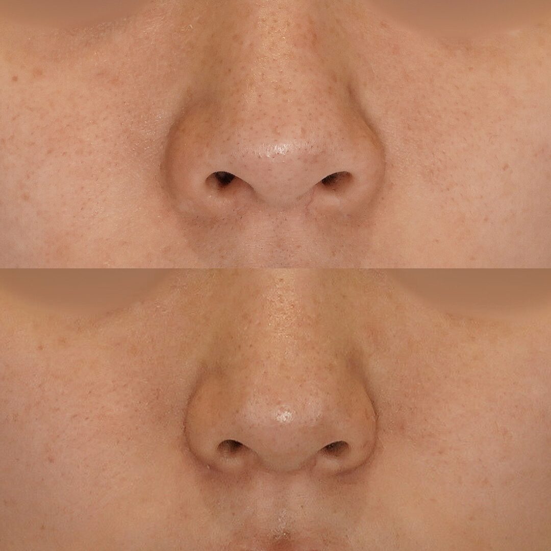 鼻翼縮小（小鼻縮小）