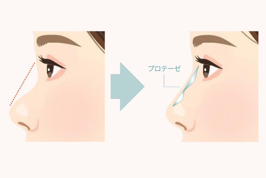 鼻プロテーゼの方法