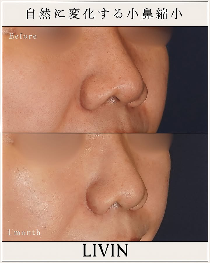 Before and After of Alar Reduction Surgery
