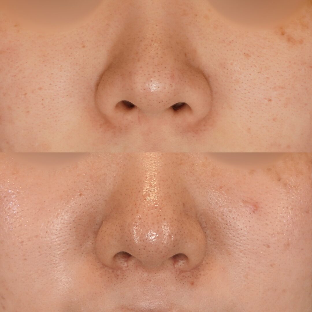 鼻翼縮小（小鼻縮小）