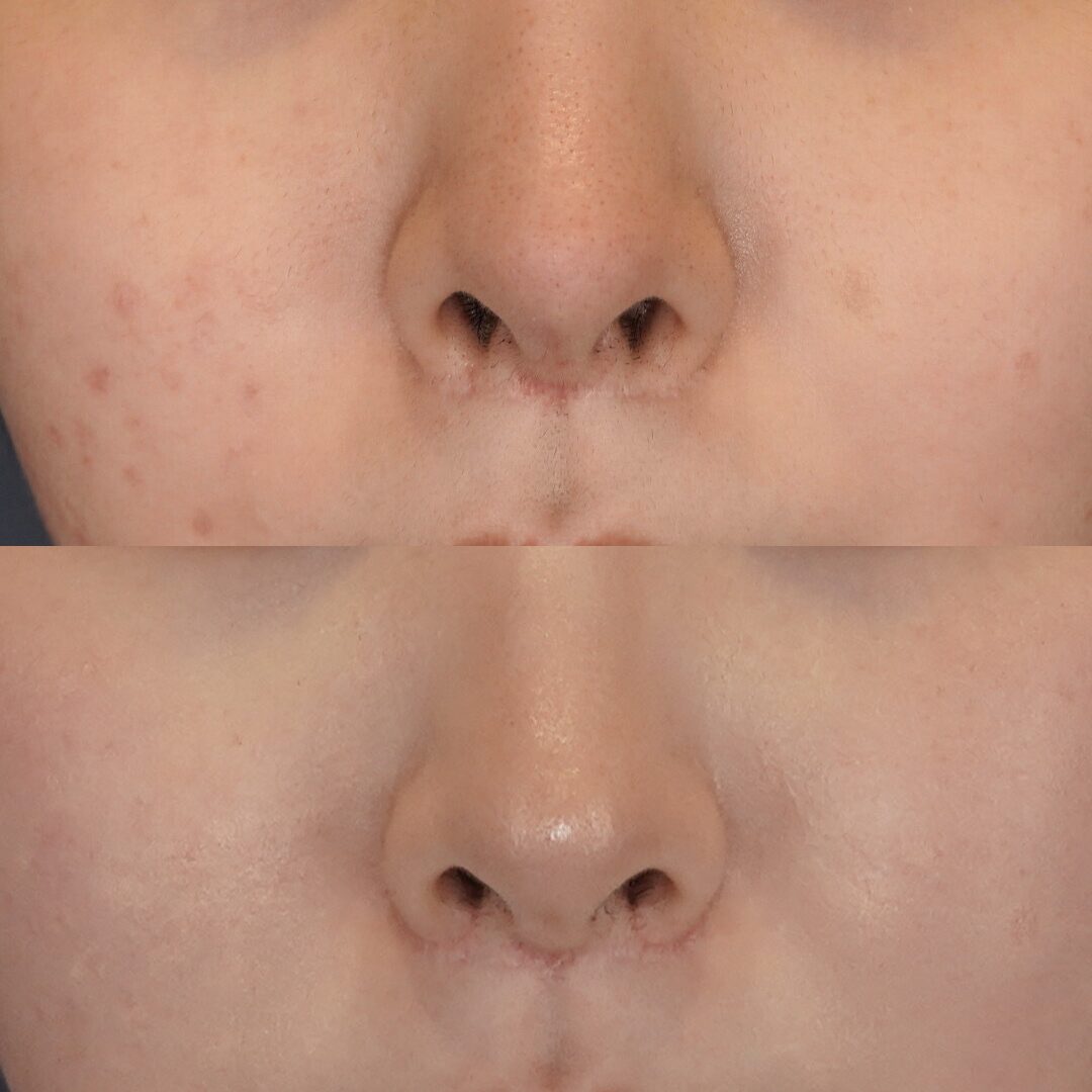 土手再建（鼻腔底再建）