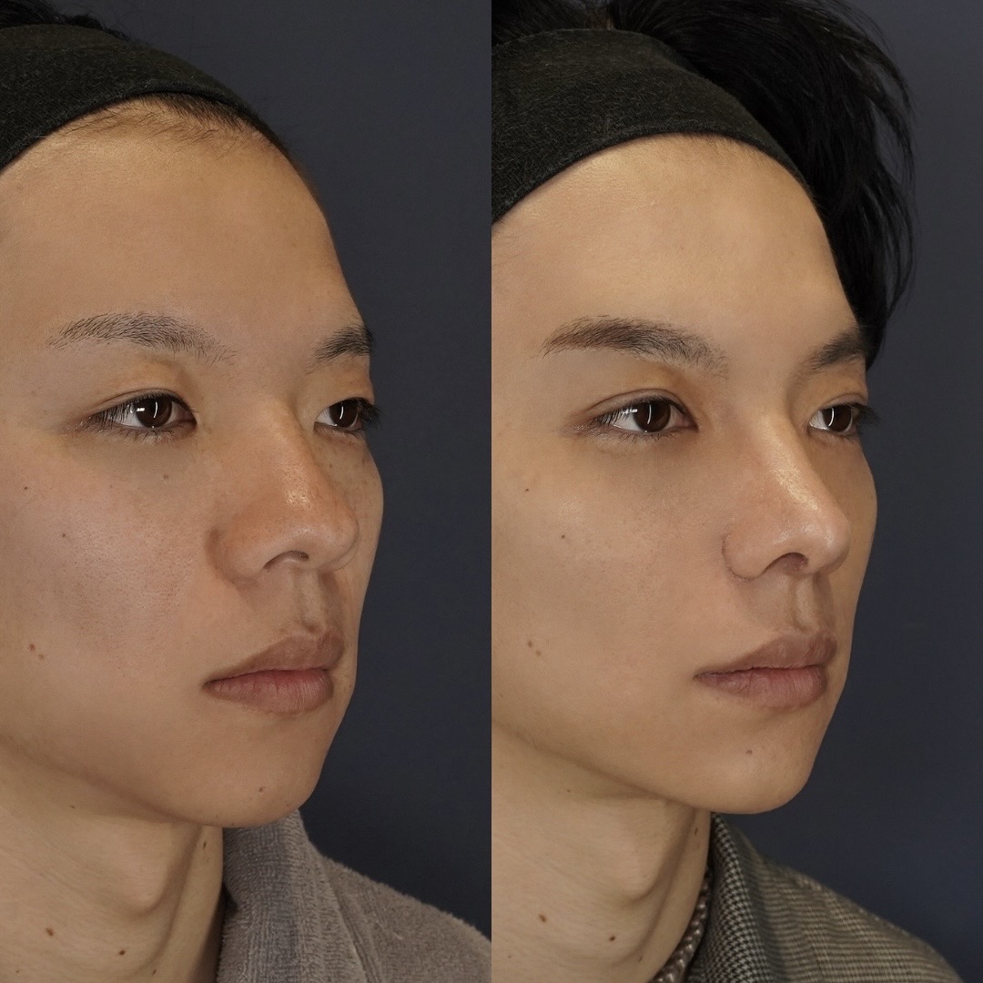 鼻尖形成、耳介軟骨移植、コルメラストラット、鼻柱下降、鼻翼縮小（内＋外）、二重埋没（４点）、目頭切開