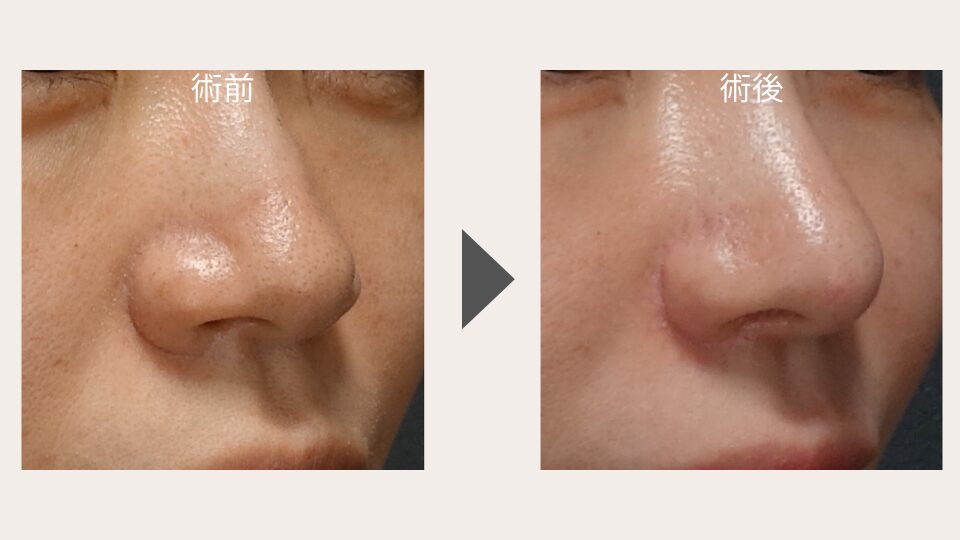 鼻翼縮小 症例