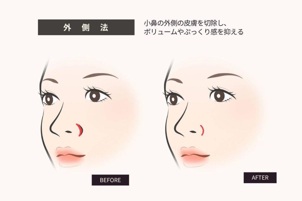 鼻翼縮小(小鼻縮小)外側法のBEFORE/AFTER図解