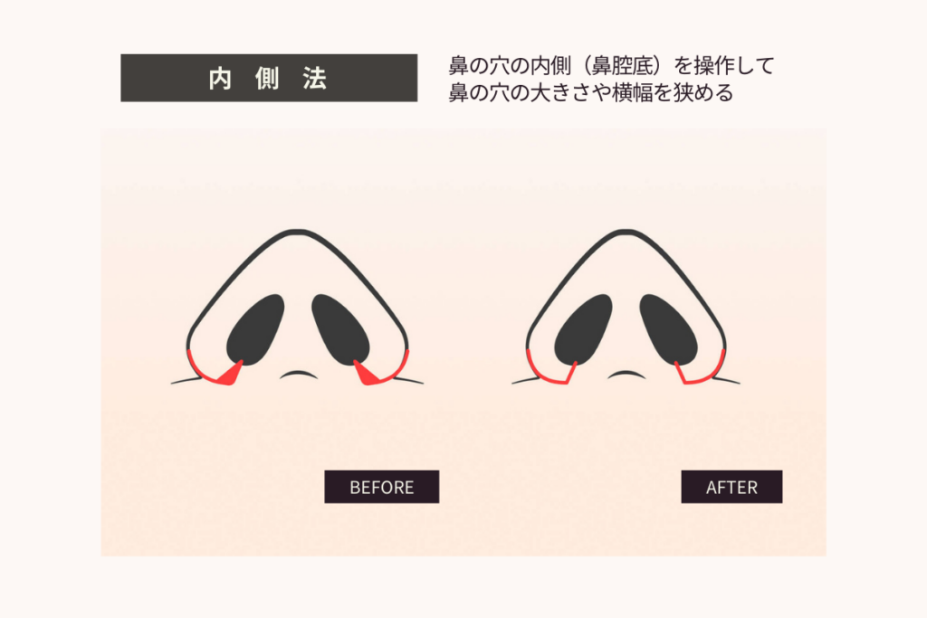 鼻翼縮小(小鼻縮小)内側法のBEFORE/AFTER図解