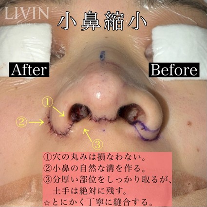 小鼻縮小の症例写真