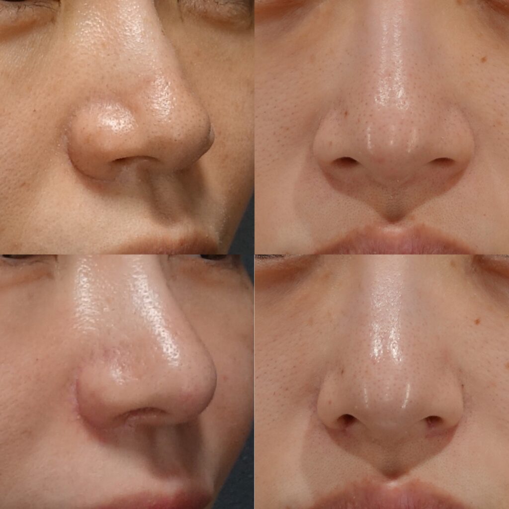 小鼻縮小の症例
