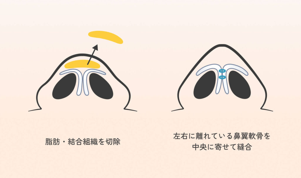 鼻尖形成の施術方法の図解