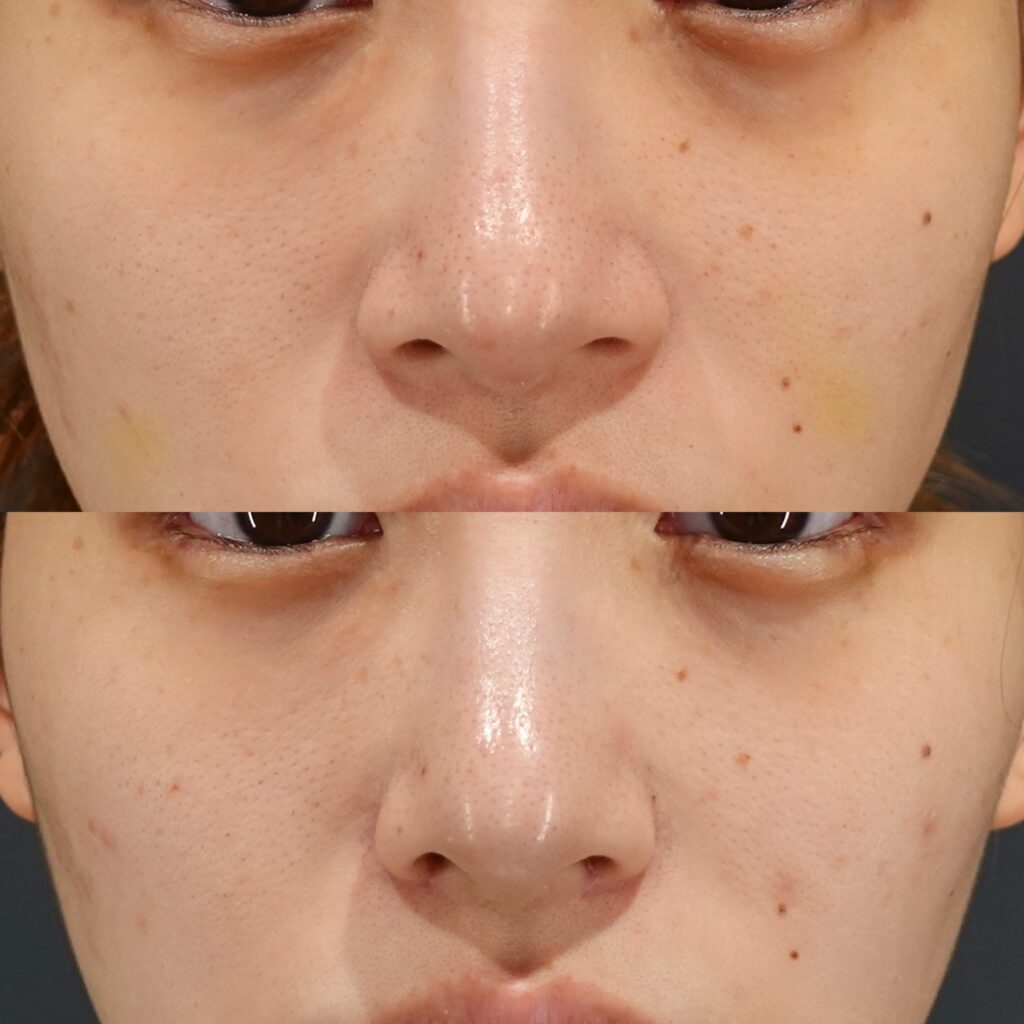 LIVIN CLINICの鼻尖縮小の自然な仕上がりイメージ