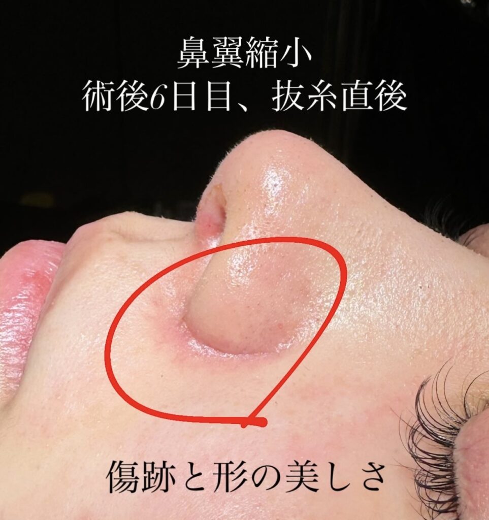 鼻翼縮小外側の抜糸直後の傷痕