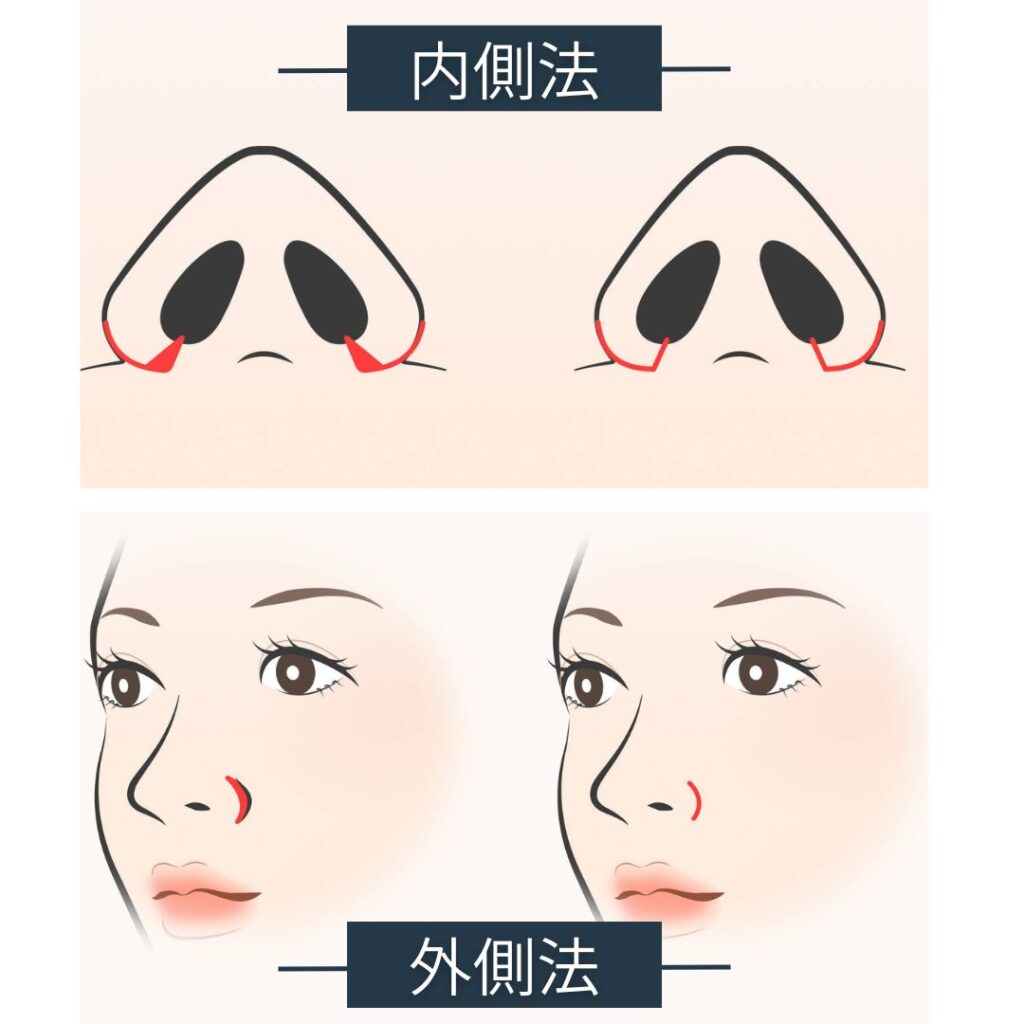 小鼻縮小の内側法と外側法の図解