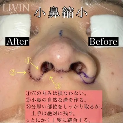 鼻翼縮小内側、外側のデザイン説明