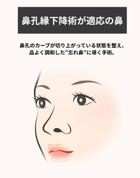 鼻孔縁下降が適応の鼻