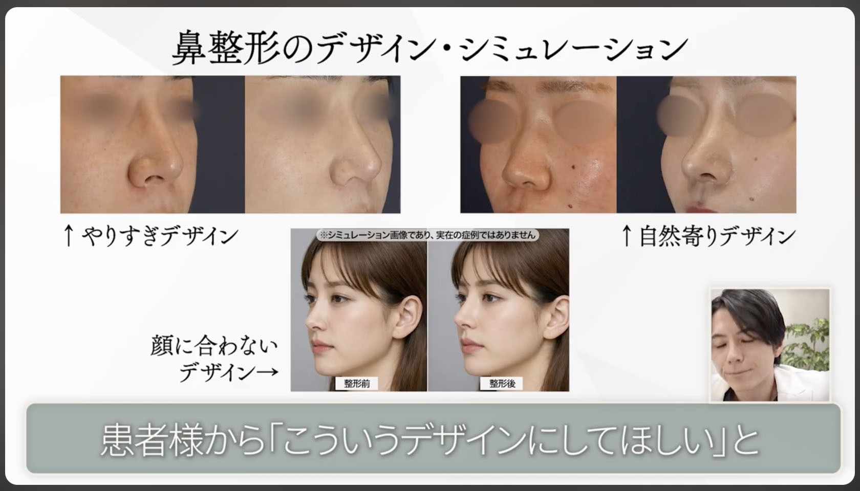 鼻整形のデザイン・シミュレーション