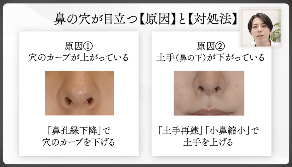 鼻の穴が目立つ【原因】と【対処法】