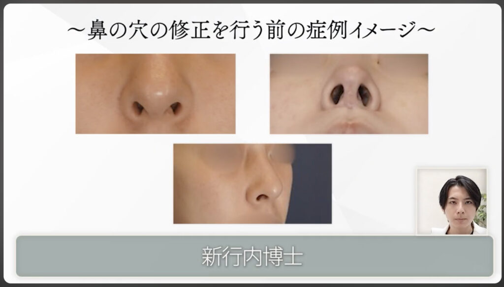 鼻の穴の修正を行う前の症例イメージ