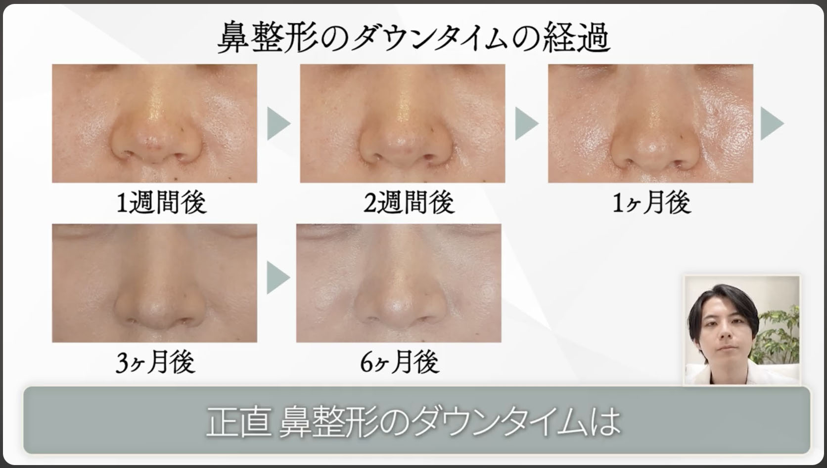 鼻整形のダウンタイムの経過