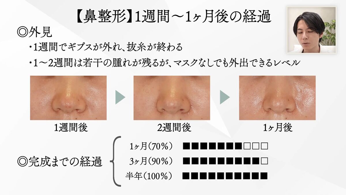 【鼻整形】1週間~1ヶ月後の経過