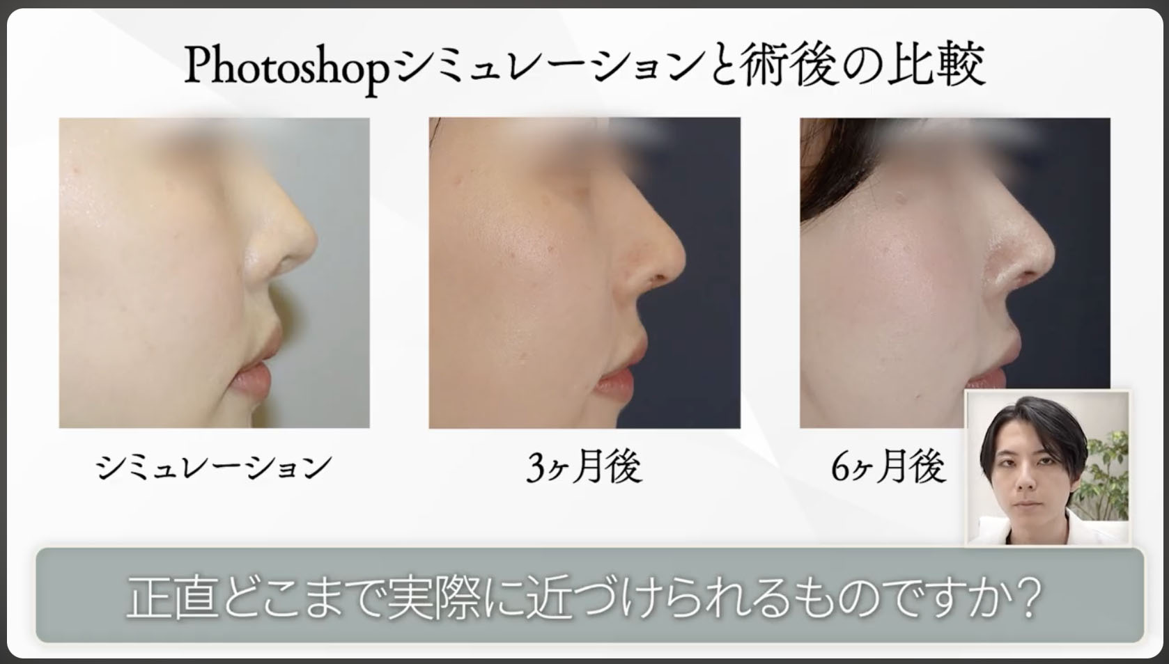 Photoshopシミュレーションと術後の比較