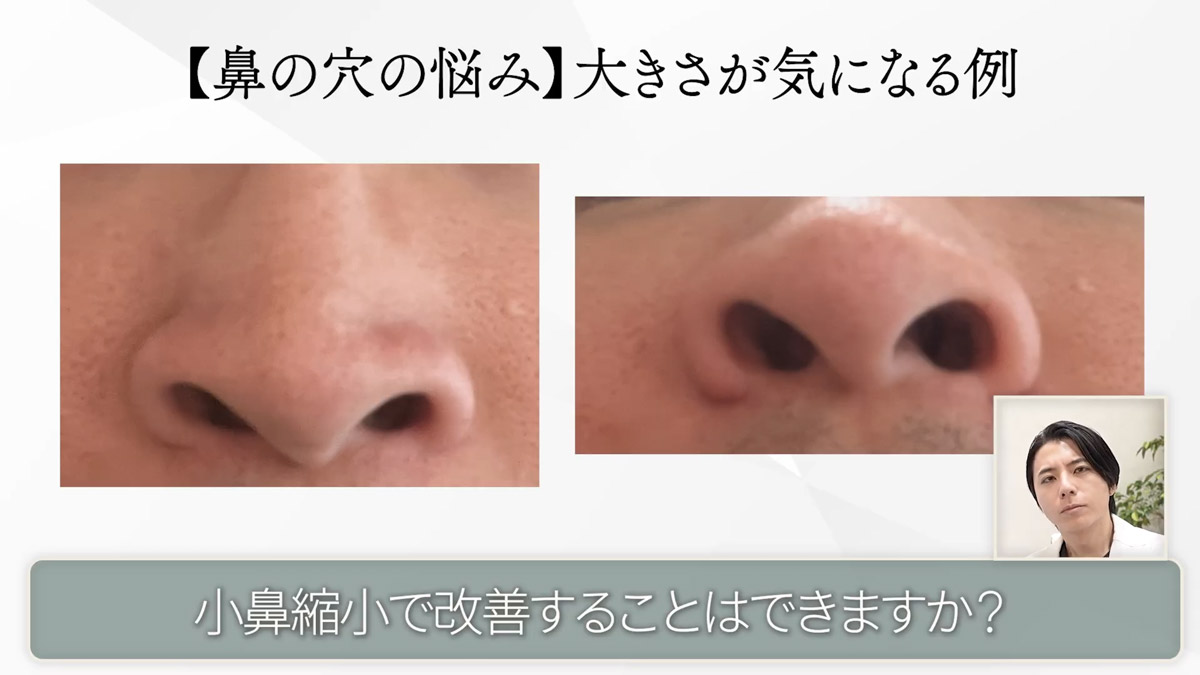 小鼻縮小(鼻翼縮小)で鼻の穴は本当に小さくなる?