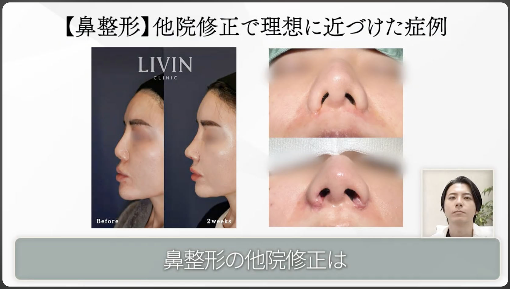 【鼻整形】他院修正で理想に近付けた症例