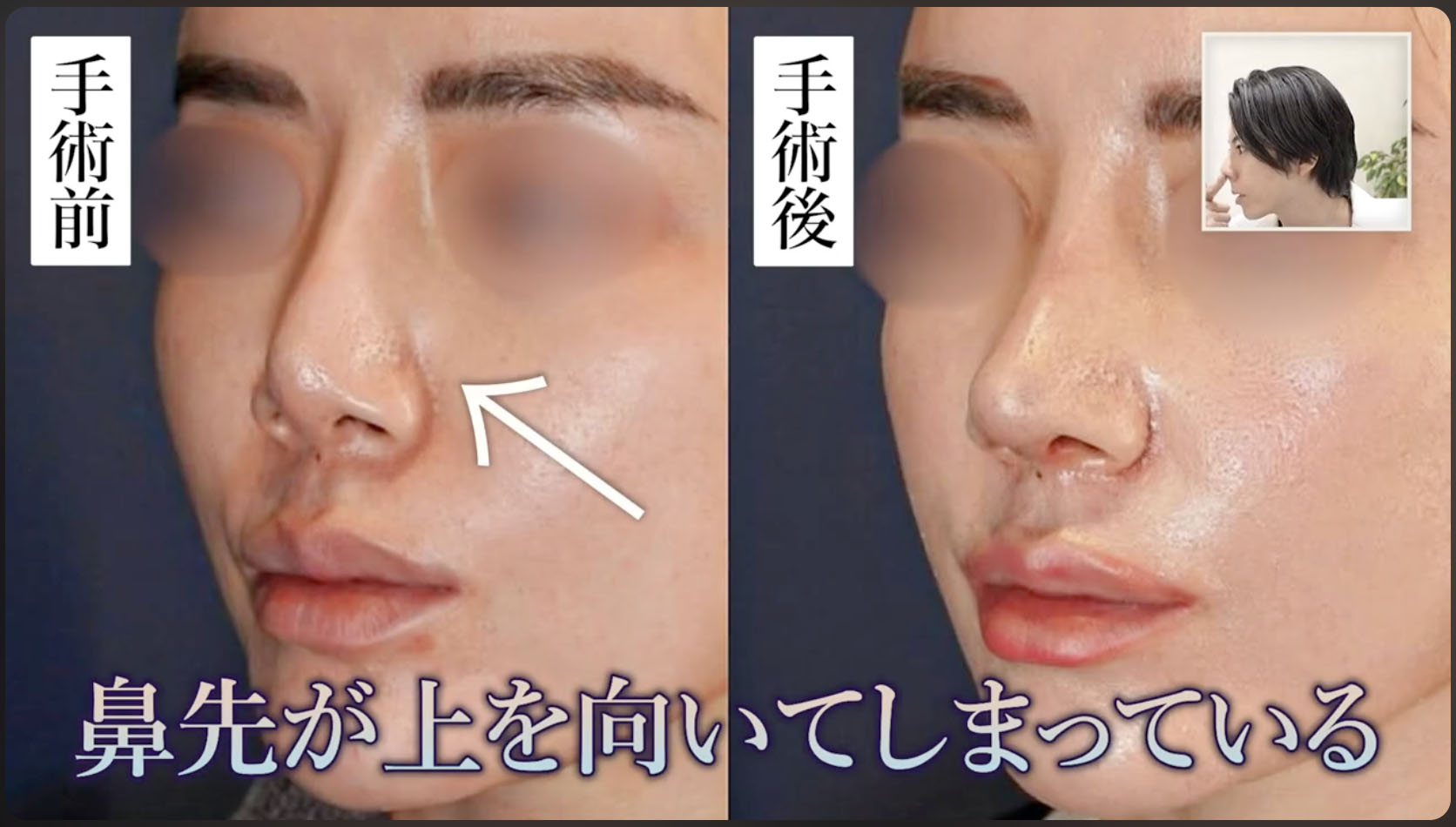 症例①:拘縮で鼻先が上を向いてしまったケース(プロテーゼ抜去+肋軟骨で再建)