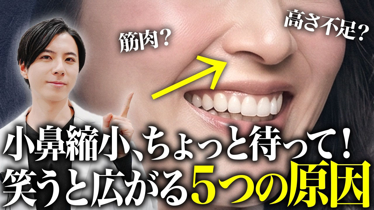 笑うと"小鼻が気になる"5つの原因「小鼻縮小する前に見て!」