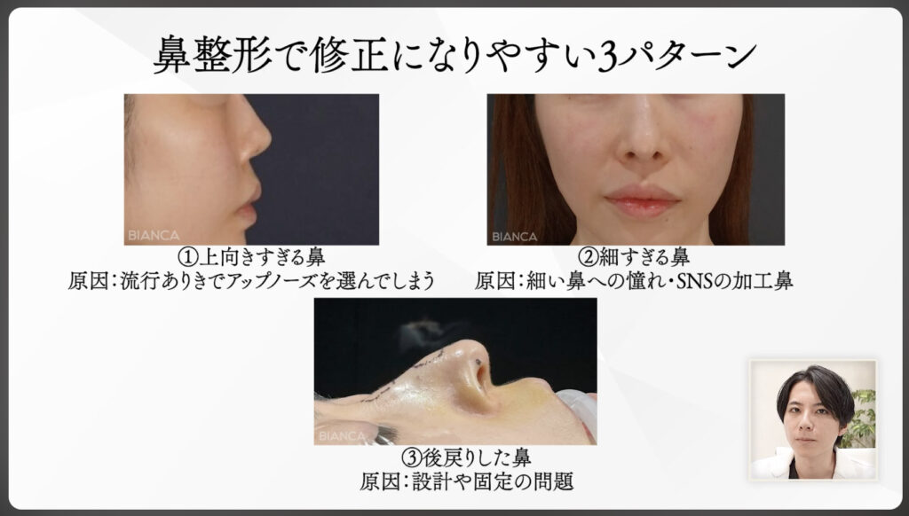 鼻整形で修正になりやすい3パターン