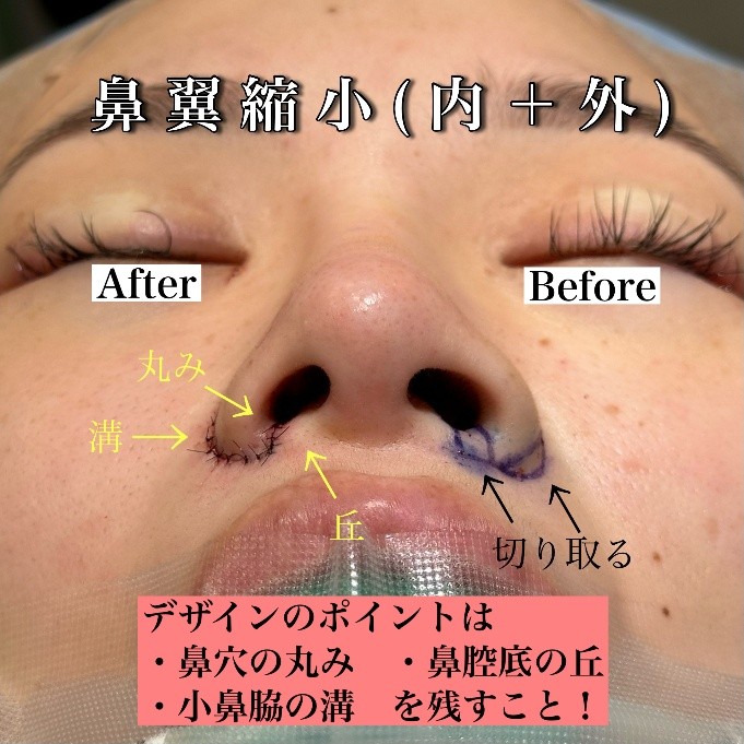 鼻翼縮小のビフォアフ画像