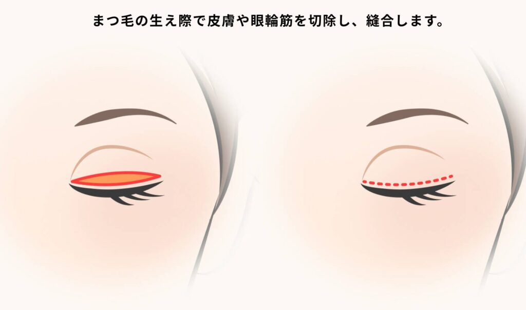 睫毛上皮膚切除の施術内容を表したイラスト
