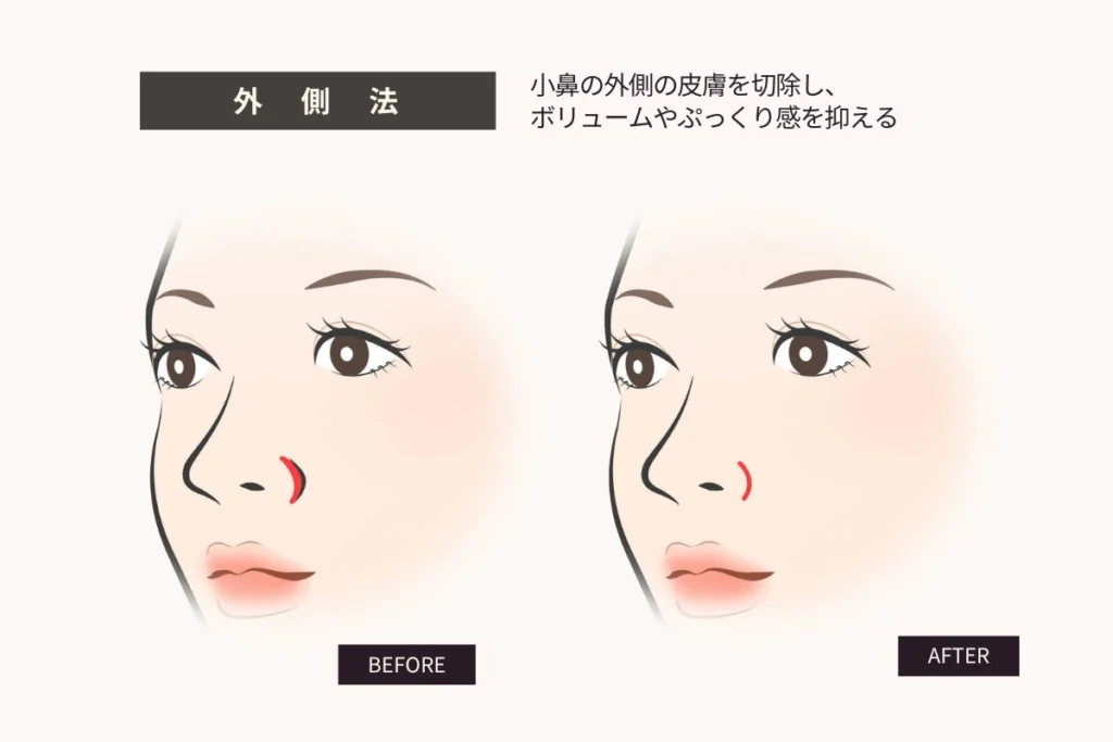 小鼻縮小の外側法の図解