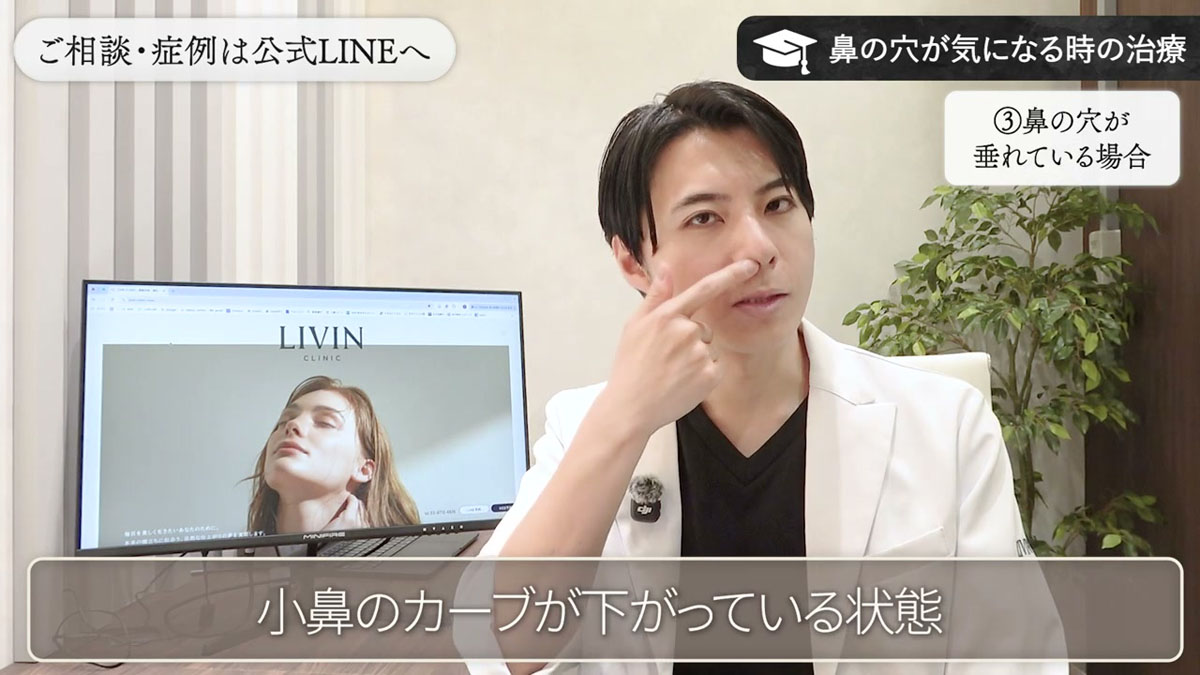 パターン③|鼻の穴が垂れて重く見える場合