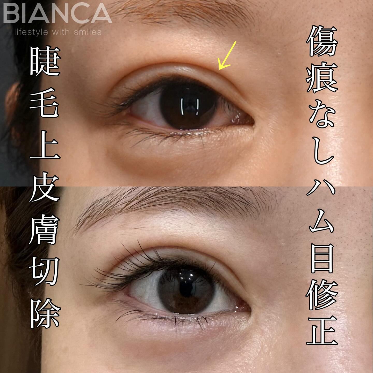 症例① ― まつ毛の上の皮膚を数ミリ切除する