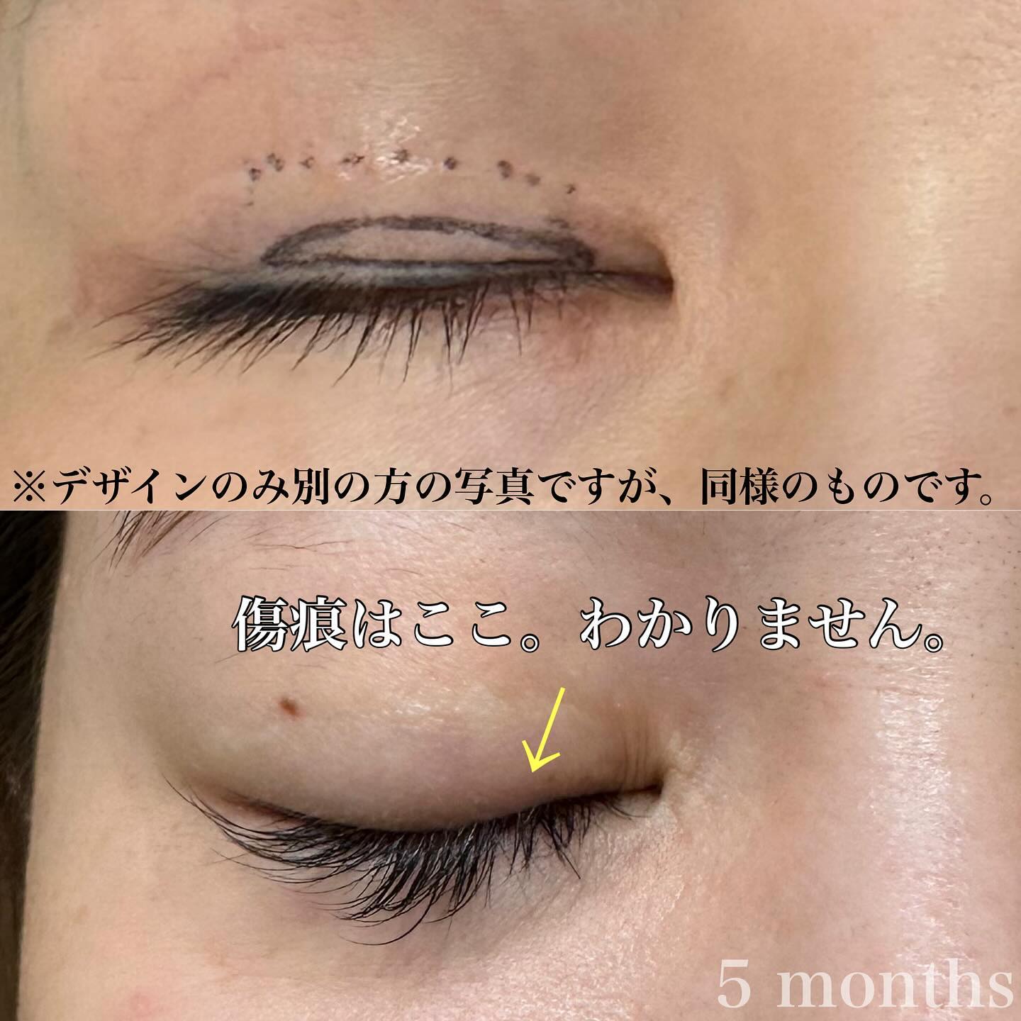 症例① 睫毛上皮膚切除